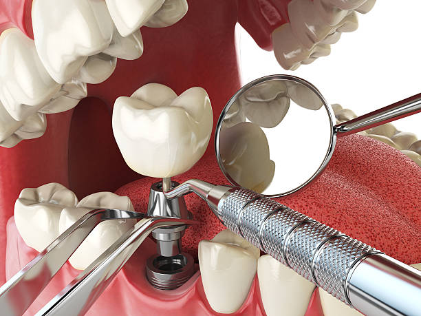 Best Emergency Tooth Extraction in Liberty Corner, NJ